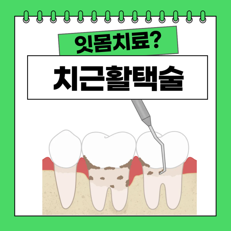 치근활택술이 뭔가요? 스케일링과 차이, 잇몸치료 과정 총정리