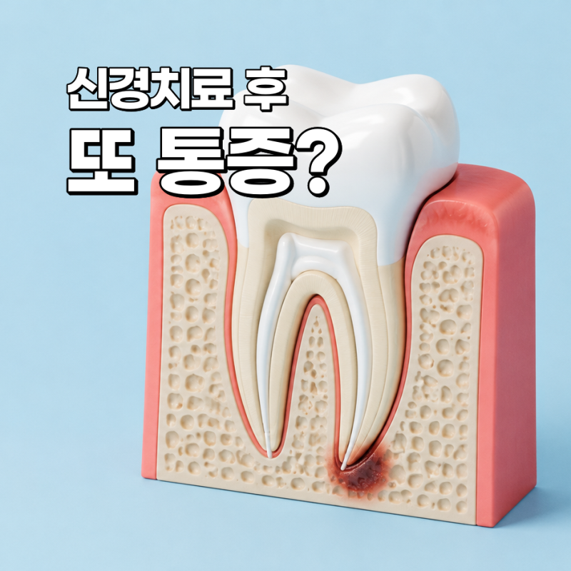 재신경치료가 필요한 경우｜치료 과정과 회복 기간, 치료 후 관리