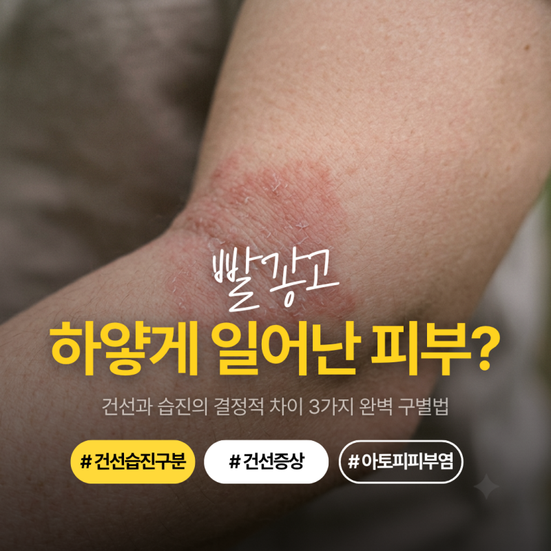건선 습진 구분, 붉은 반점과 하얀 각질 어떻게 다를까? 핵심 차이 3가지와 피부염 관리법