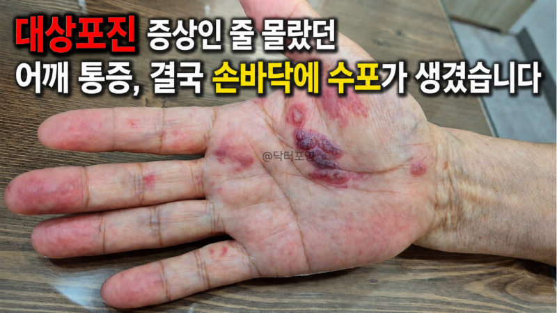 대상포진 초기 증상, 수포보다 먼저 시작된 어깨 통증