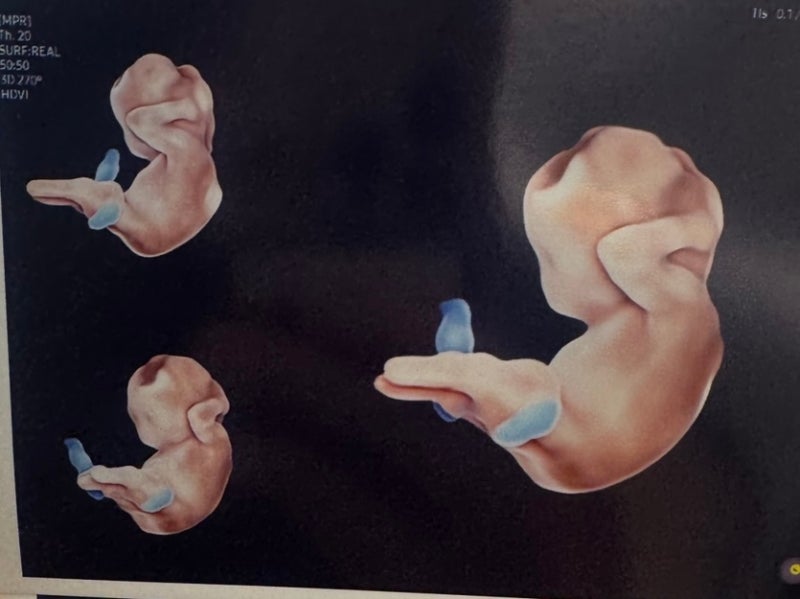 임신 14주,15주,16주,17주차 기록-임신 중기 입덧, 임산부 목감기, 입체초음파, 임신중기 입덧, ....
