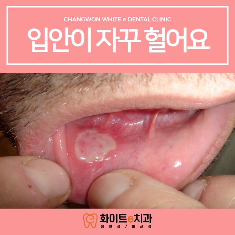 입안이 자꾸 헐어요, 구내염 원인과 빨리 낫는 방법