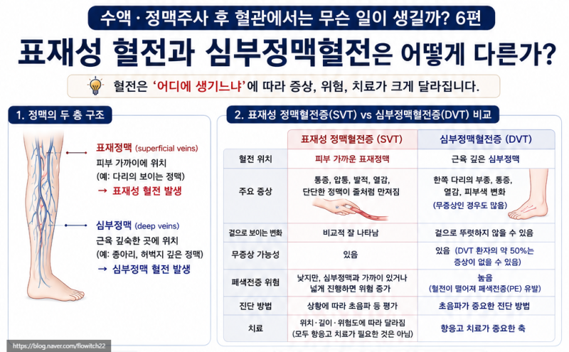 표재성 혈전(SVT)과 심부정맥혈전(DVT)은 어떻게 다른가?⑥