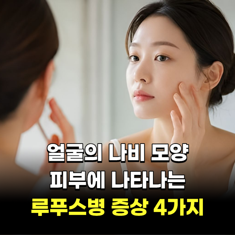 "얼굴에 나비 모양.." 피부로 나타나는 루푸스병 증상 4가지