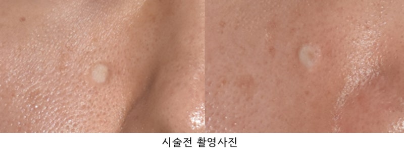오래된 수두흉터 자국 치료 케이스 :: 해율한의원 울산점