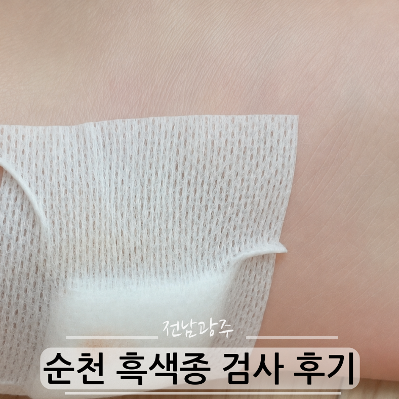 순천 흑색종 검사 후기│ 멜라닌세포성모반