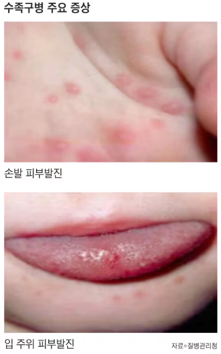 어린이집 수족구 비상! 전염성·격리기간·완치기준 총정리 (등원 가능 시기는?)