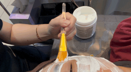 부산쥐젖제거한의원ㅣ서면편평사마귀제거 마취크림부터 후관리까지 솔직 후기
