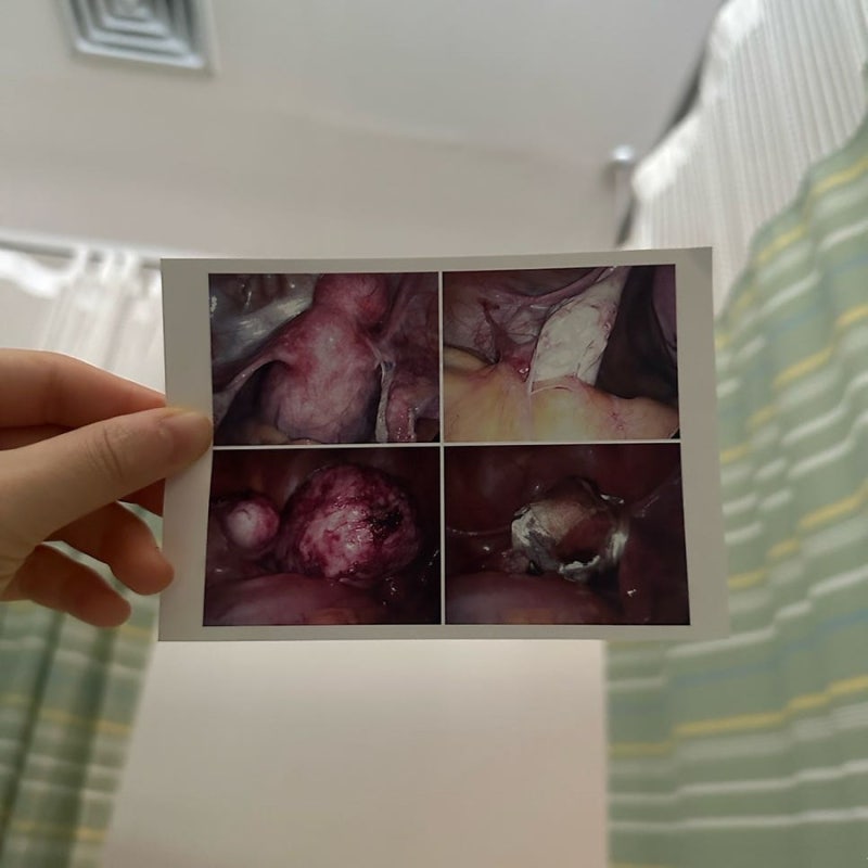 대구 자궁근종 수술 미래여성병원 평활근종 복강경 10센티 수술 후기 입원 꿀팁