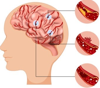 뇌졸중 뜻과 초기증상, 전조증상 총정리, 허혈성 뇌졸중 뇌경색 원인 검사 치료 방법