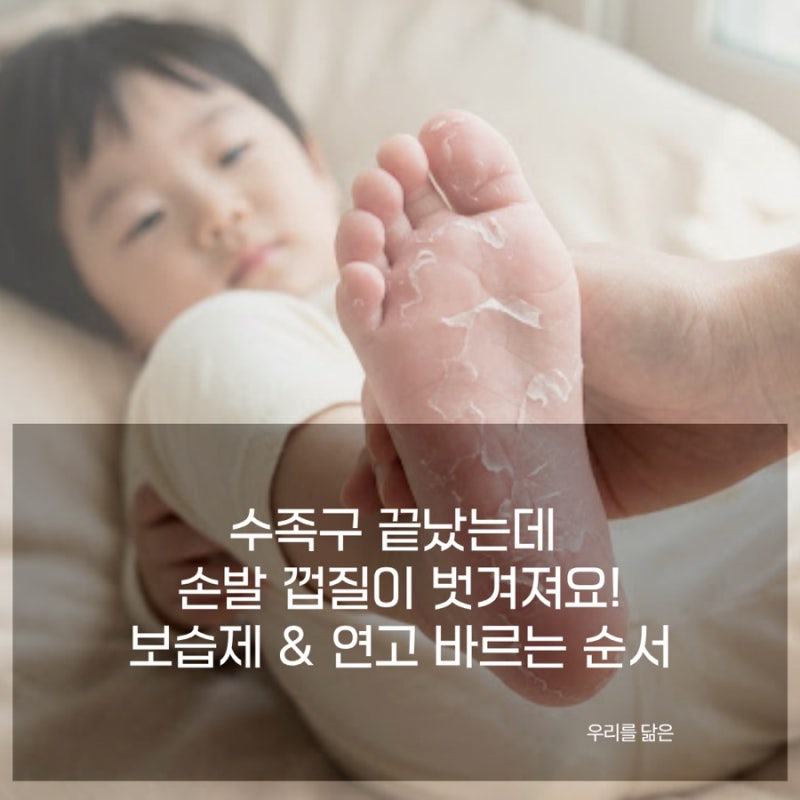 수족구 후유증 피부 껍질 벗겨짐에 좋은 저자극 보습제 및 연고 바르는 법