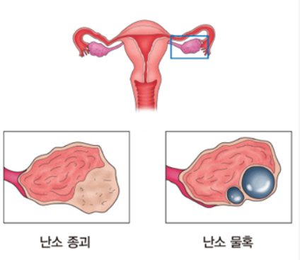 갑자기 내몸에 난소 물혹?! 중년여성에게 찾아온 비만과 식습관, 그리고 운동의 힘!!