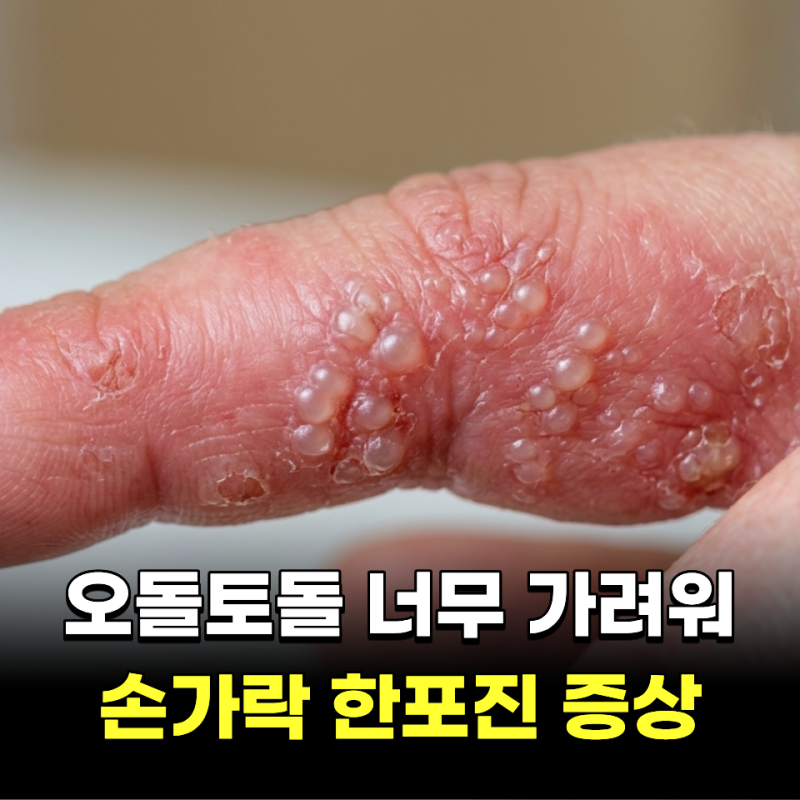 "오돌토돌 너무 가려워.." 손가락 한포진 증상 TOP4