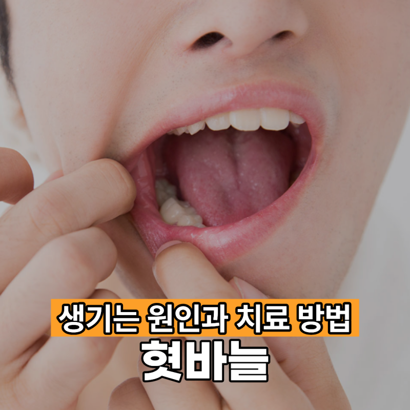 혓바늘 생기는 원인과 관리 방법