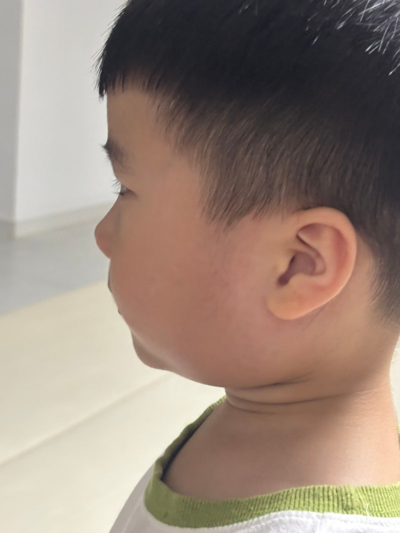 유아 침샘염 증상, 볼거리 차이점 5살아이 치료 후기