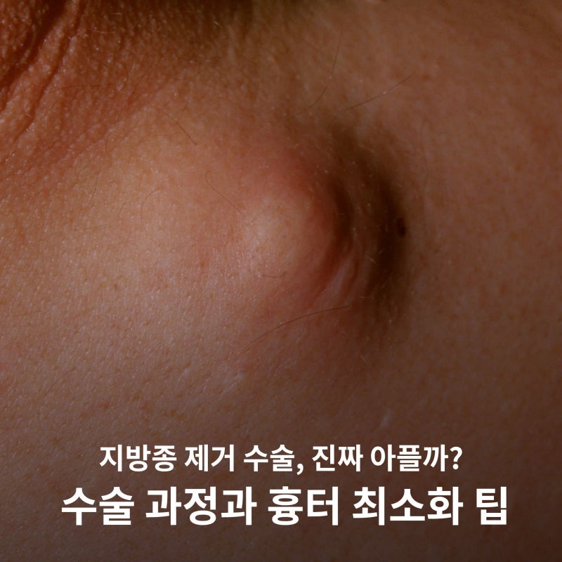 지방종 제거 수술, 진짜 아플까? 수술 과정과 흉터 최소화 팁