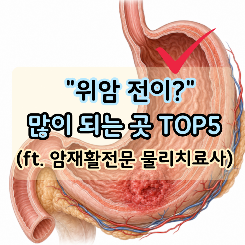 "위암 전이 잘 되는 부위 5곳" 가장 흔한 곳은 간일까?