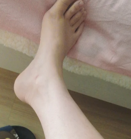 발등 골절 증상 멍이 들고 붓기 시작할 때 구별하는 방법