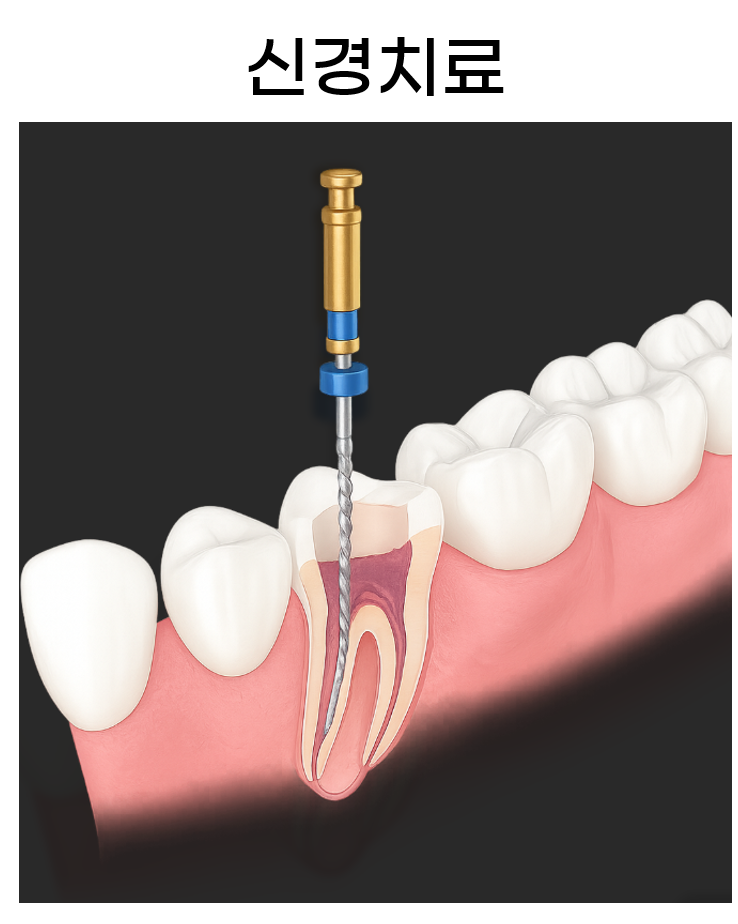 군포 산본동 치과 신경치료 후 크라운 안하면? 쪼개질 수 있습니다.