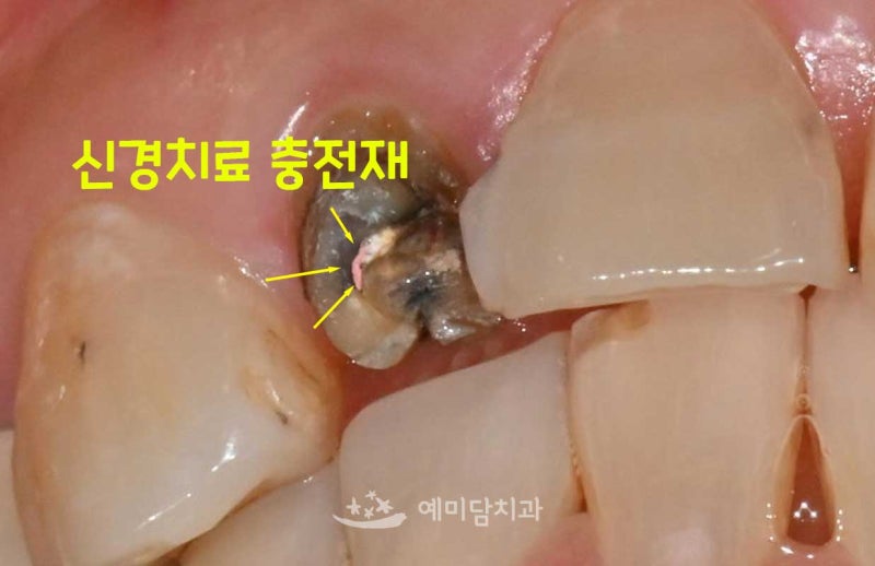 군산내흥동치과 / “앞니 크라운이 갑자기 빠졌어요.” 오래된 레진까지 함께 다시 치료한 ....