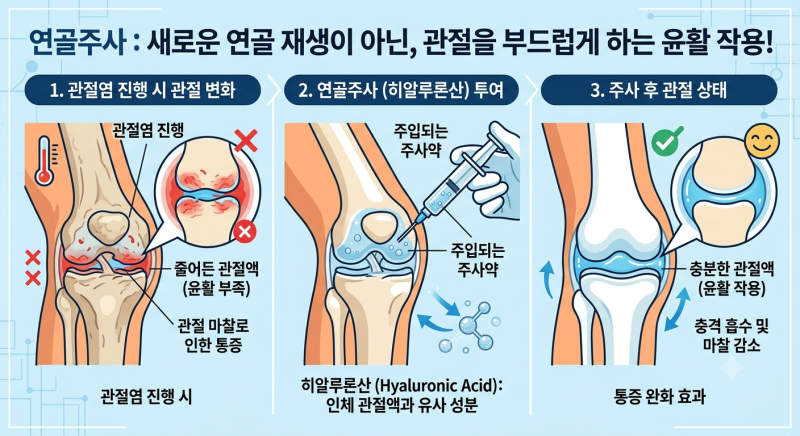 무릎 연골주사, 맞으면 정말 연골이 재생될까요? (종류, 주기, 효과 총정리)