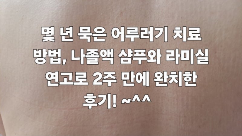 몇 년 묵은 어루러기 치료 방법, 나졸액 샴푸와 라미실 연고로 2주 만에 완치한 후기! ~^^
