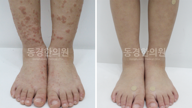 소아 자반증 병원 고르는 기준