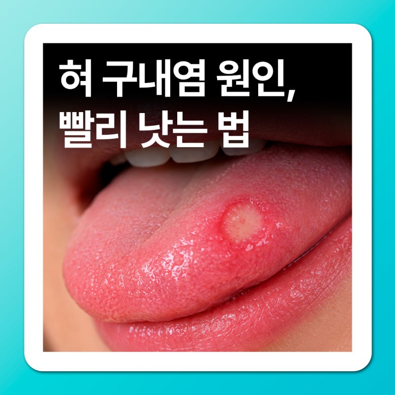 혀 구내염 원인 3가지, 입병 빨리 낫는 법은 뭘까요?