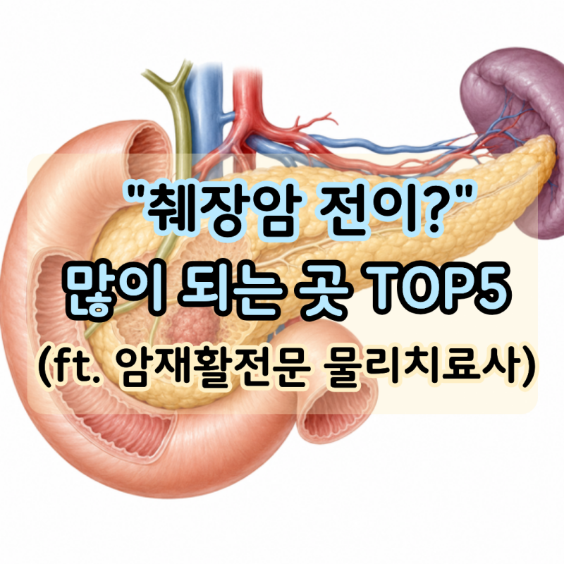 "췌장암 전이 잘되는 부위 5곳" 가장 흔한 곳은 간?