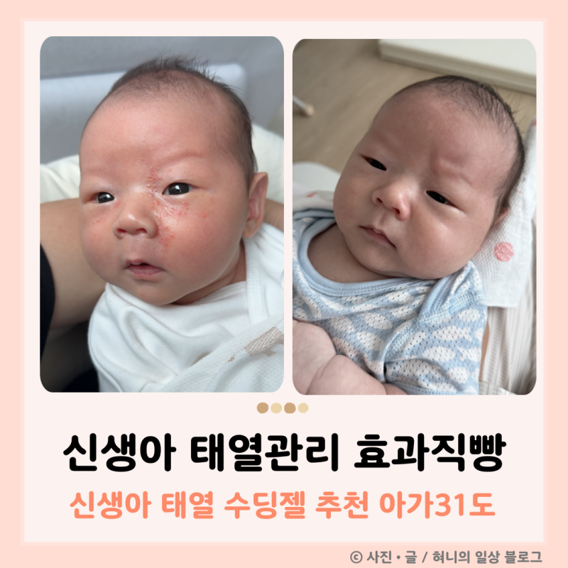 신생아 태열 수딩젤 효과직빵 아가31도 일주일 관리 변화 찐후기