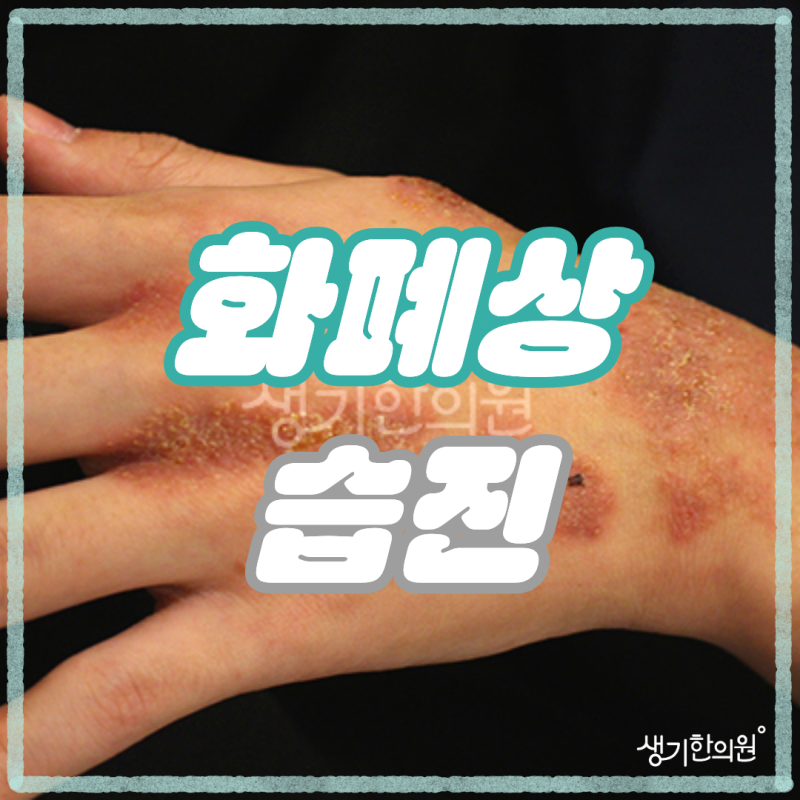의정부 화폐상습진 치료 방법, 동전 습진의 굴레에서 벗어나는 확실한 가이드