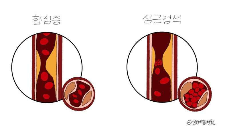 왼쪽 가슴통증, 심장질환의 신호일까요?