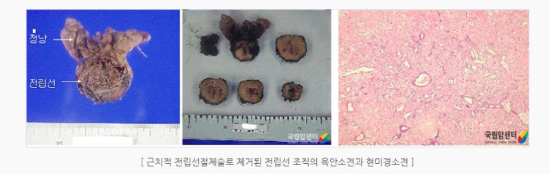 전립선암생존율, 1기부터 4기까지 왜 차이가 날까?