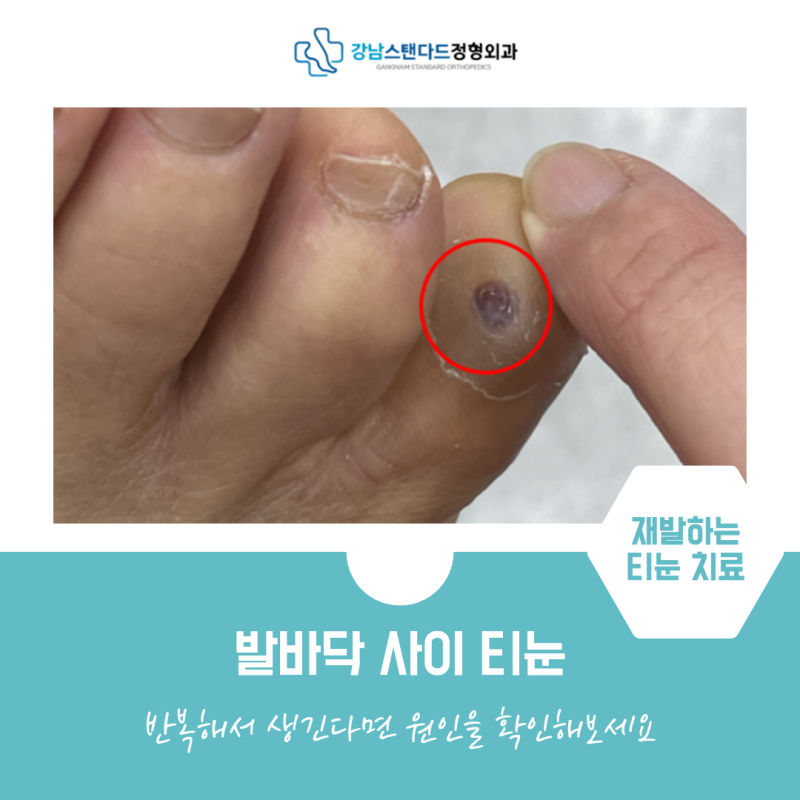 발가락 사이 티눈, 반복해서 생긴다면 원인을 확인해보세요