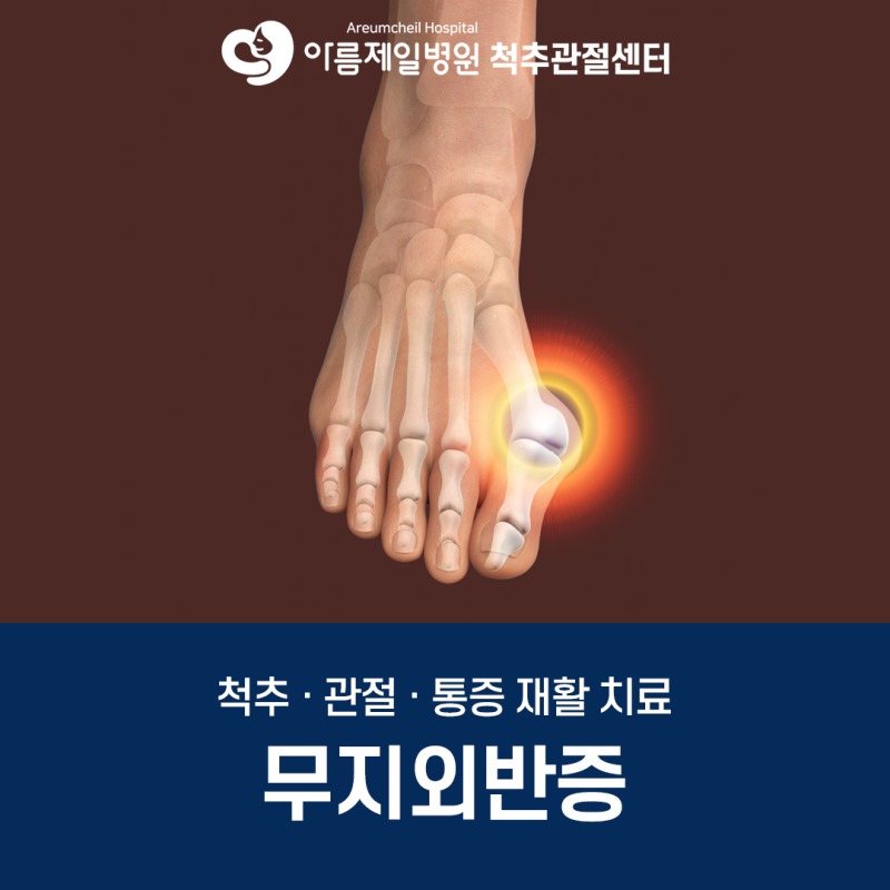 신도림정형외과 무지외반증, 엄지발가락이 휘었다면?
