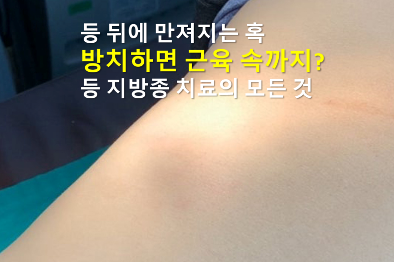 근육 내 등 지방종, 꼭 수술로 제거해야 할까요?