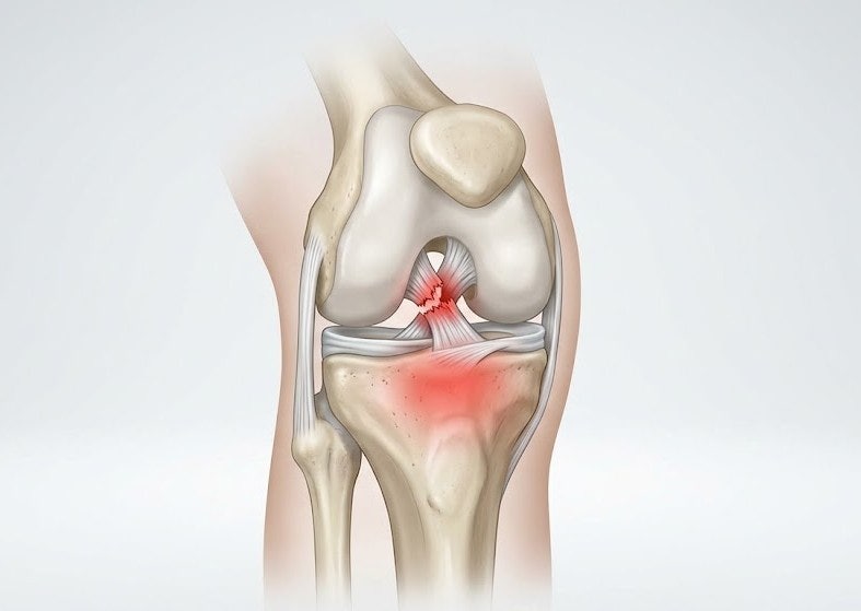 대전무릎통증, 뚝 소리 후 십자인대파열 의심해봐야 하는 이유
