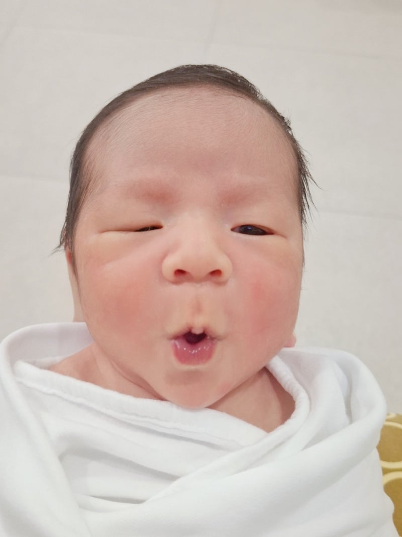 신생아 선천 안검하수, 소아안과에서 10개월에 진료받은 기록