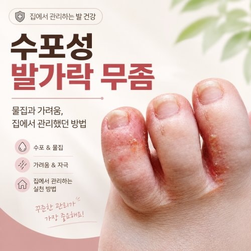 수포성 발가락 무좀 물집과 가려움, 집에서 관리했던 방법