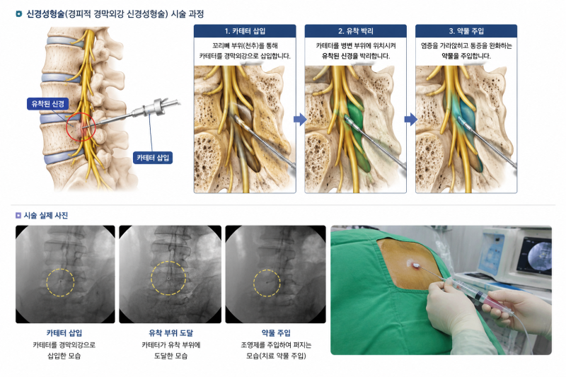 신경성형술 수술비 받을 수 있을까요? 종수술비·실손보험까지 정리
