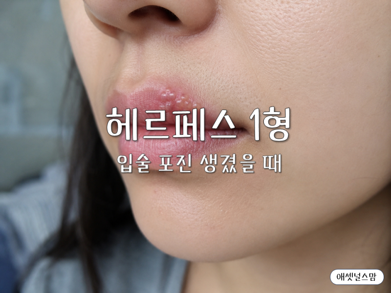 입술에 물집이 잡힌다면, 헤르페스 1형 증상과 관리법