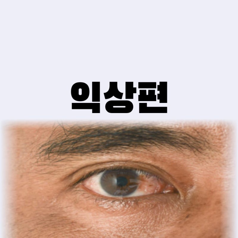 눈에 하얀 살이 차올라요 익상편 수술, 째기만 하면 다시 자라나는 이유