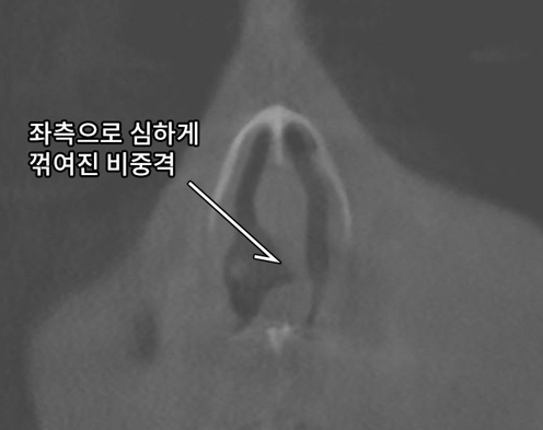 비중격만곡증성형외과 이비인후과 명의 찾아야 하는 이유