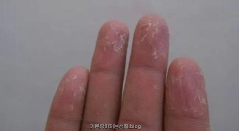 한포진 연고 손가락 발가락 물집 케어 꿀팁