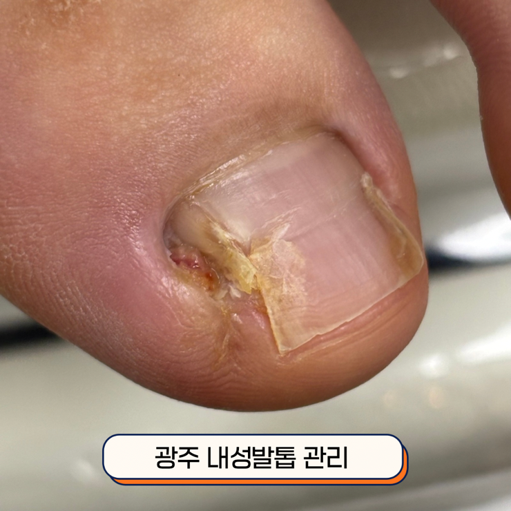 광주 내성발톱, 수술 후 재발 원인과 3회 관리과정