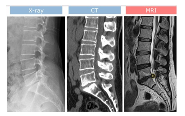 척추 MRI 찍을 때 반드시 알아야 할 것들