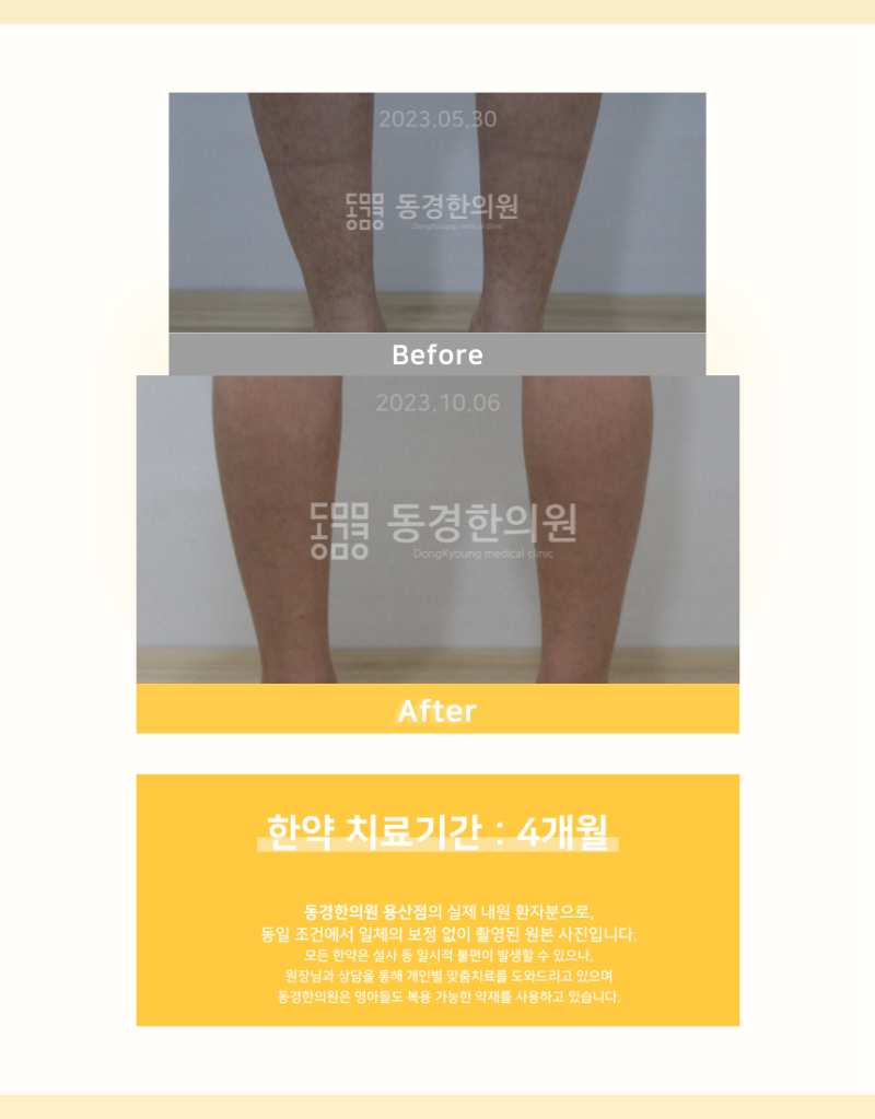 몸에 빨간 두드러겨 가려움, 자반증이라면 빠른 치료가 관건입니다.