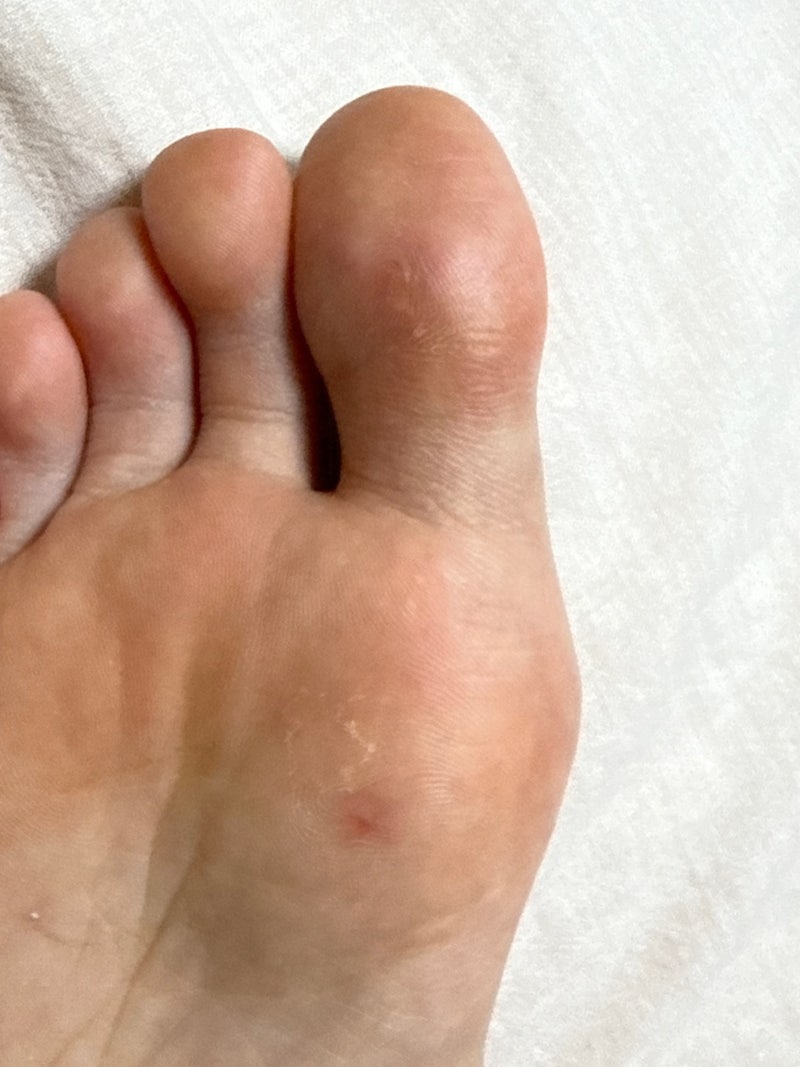 13년 된 발바닥 사마귀 블레오마이신 치료 통증과 상세후기 (1일~17일)및 부산 병원 정보