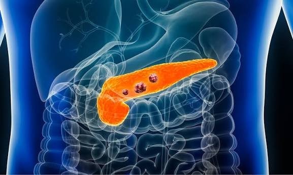 췌장암 Pancreatic cancer, 가장 늦게 말하는 암을 먼저 알아듣는 법