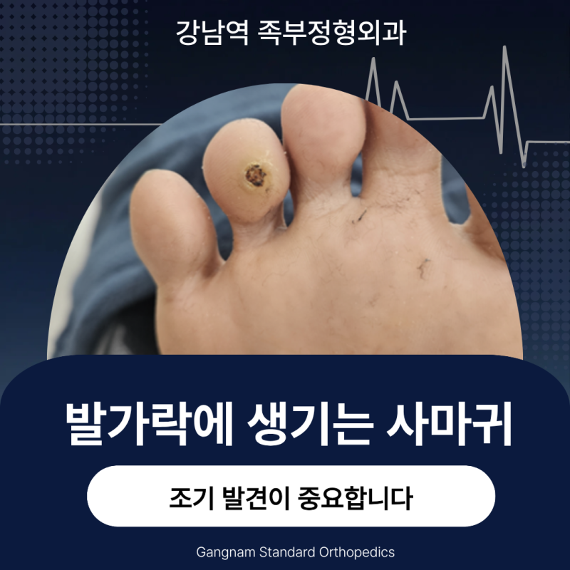 발가락에 생기는 사마귀, 조기 발견이 중요합니다